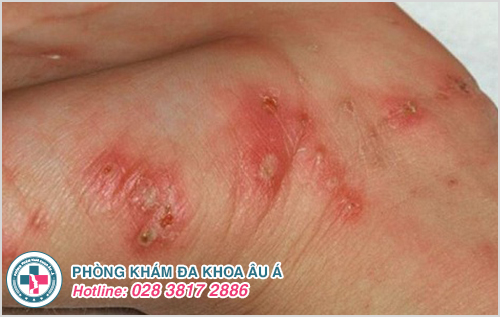 Viêm da liên cầu dạng chốc lở