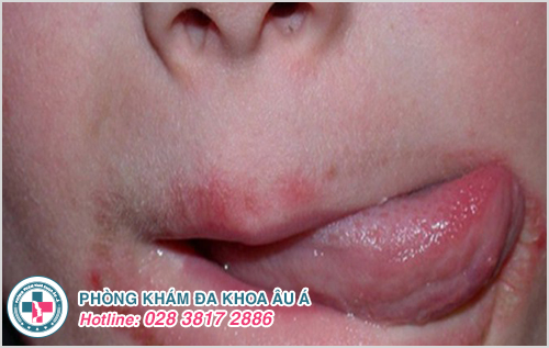 Viêm da quanh miệng : Hình ảnh nguyên nhân dấu hiệu cách trị