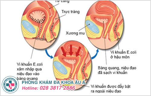 Viêm đường tiết niệu có nên quan hệ không?