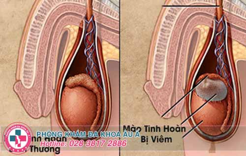 Viêm Mào Tinh Hoàn Có Quan Hệ Được Không