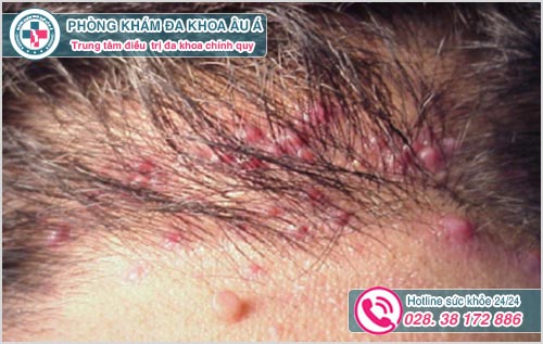 Biểu hiện viêm nang lông ở da đầu
