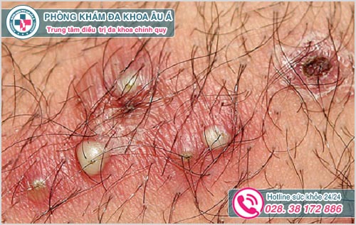 Biểu hiện của bệnh viêm nang lông ở nách