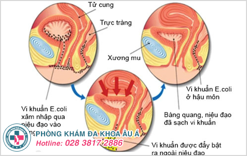 Nguyên nhân gây ra viêm niệu đạo