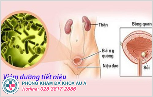 Đi tiểu buốt và đau lưng là dấu hiệu bệnh bệnh viêm đường tiết niệu 