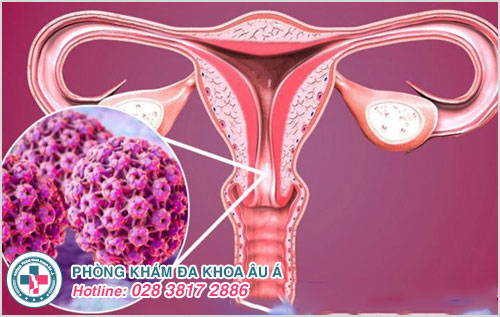 HPV gây ung thư cổ tử cung ở nữ