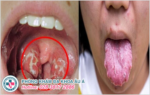 HPV gây ung thư vòm họng