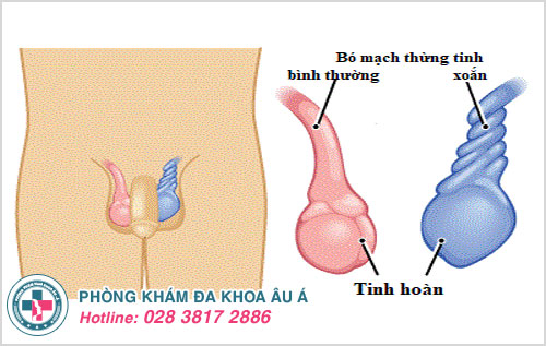 Xoắn tinh hoàn ở nam giới (ảnh minh họa)