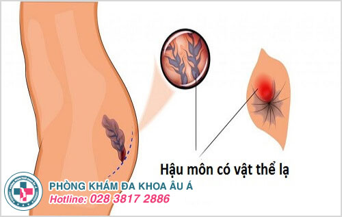 Xuất hiện dị vật ở hậu môn là bệnh gì