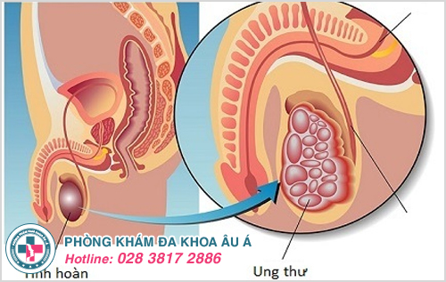 Hình ảnh minh họa mô tả bệnh ung thư tinh hoàn