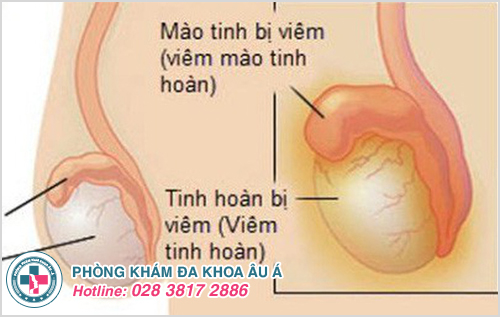 Xuất hiện hạt nhỏ tinh hoàn là dấu hiệu bệnh viêm tinh hoàn